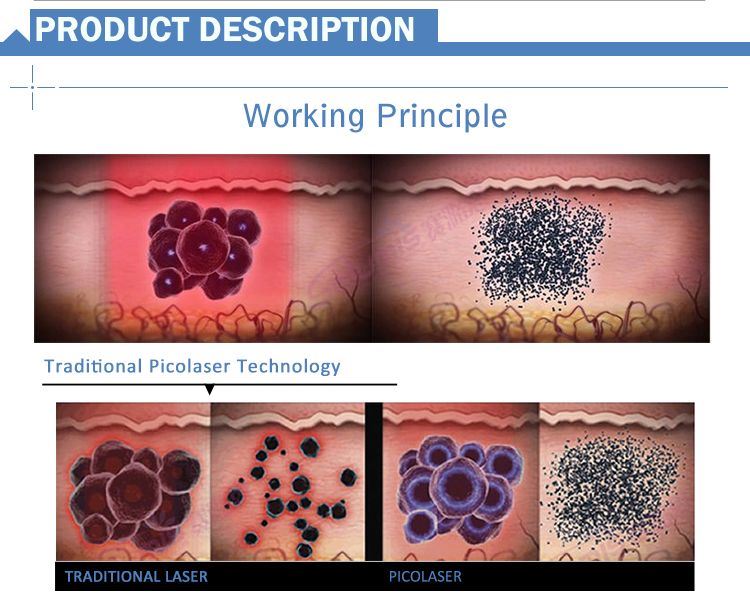 Picosecond Tattoo Removal Laser Machine