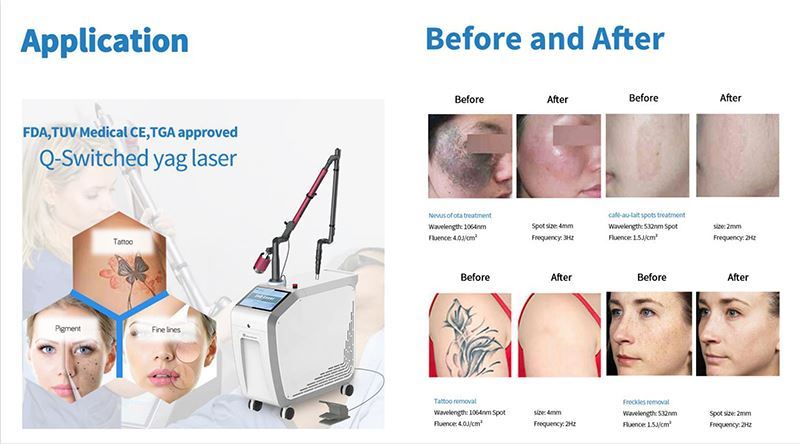 Q-laser remove acne
