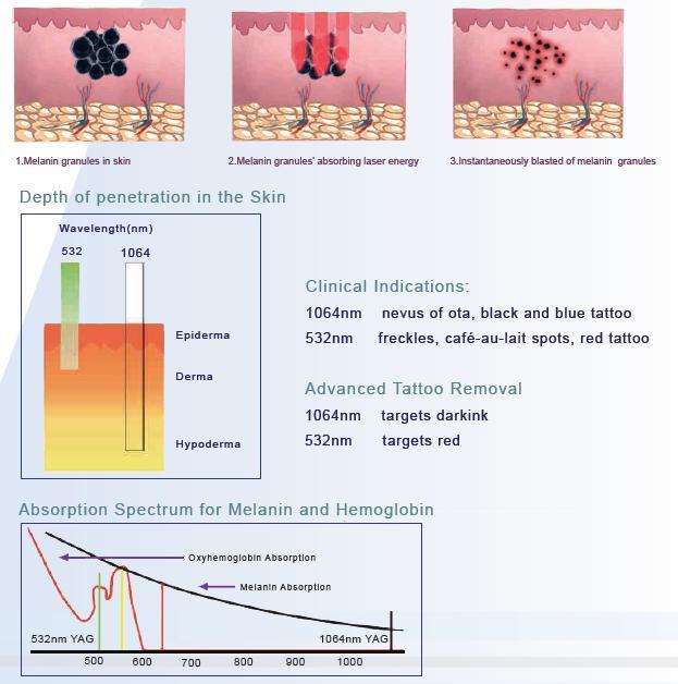 ND YAG remove tattoos whitening
