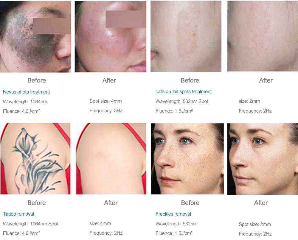 Q-Switched Nd:YAG 激光治疗系统 ExQ-Laser