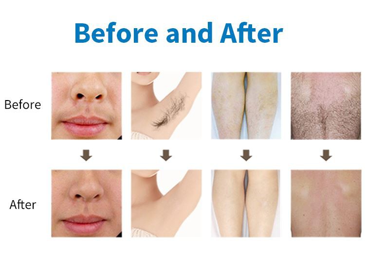 diode laser hair removalgermany