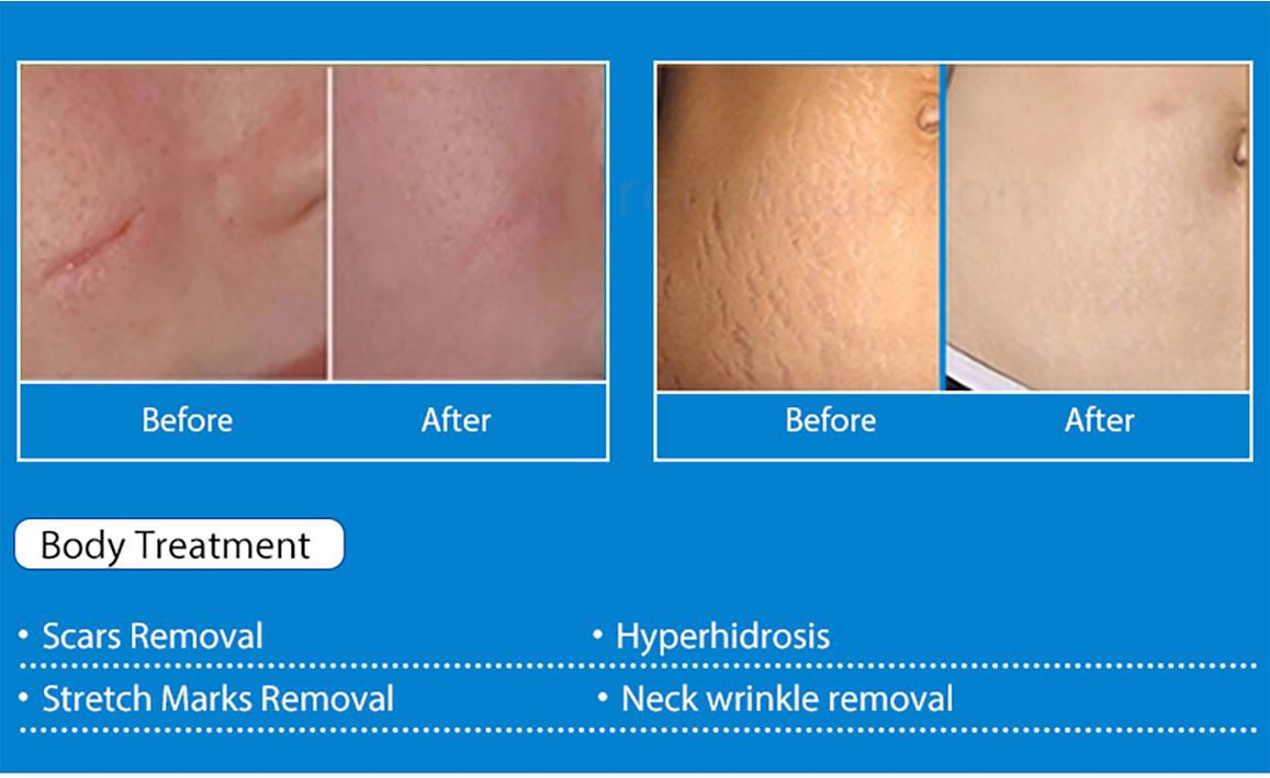 3-in-1-microneeding-(7)