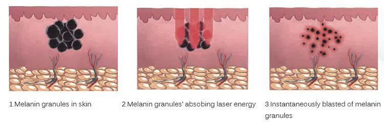 nd yag laser tattoo removal machine nd yag laser tattoo removal machine