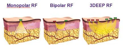 Cong_nghe_giam_beo_hieu_qua_BD-20(1)