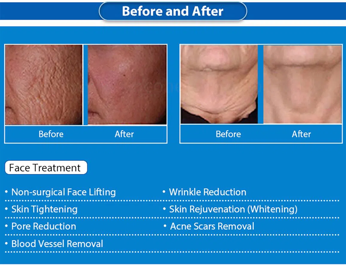 3-in-1-microneeding-(3)