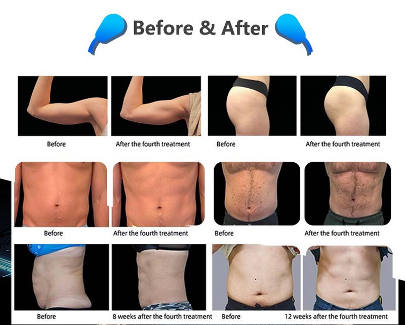 emssculpting machine