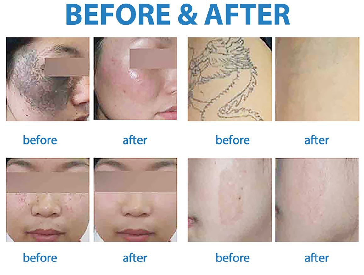 picosure tattoo removal machine