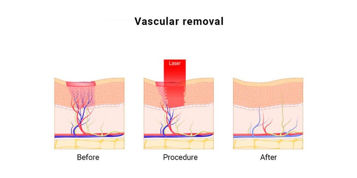 vascular removal