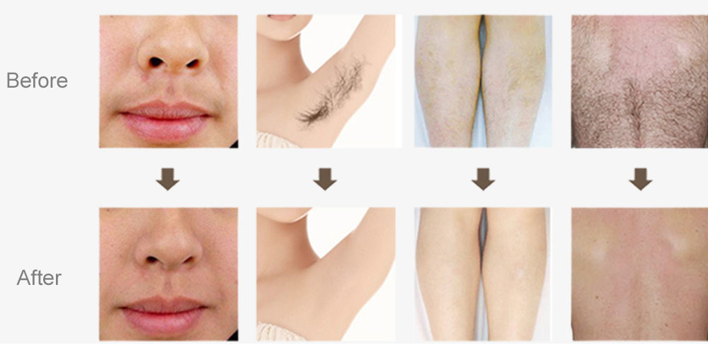 Upgraded diode laser hair removal machine