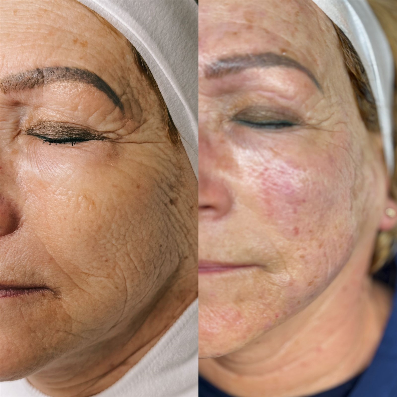 right after HIFU by Wasan