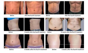 Sincosculpt Slimming machine