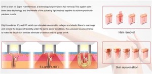IPL Hair Removal Tender Skin