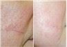 /uploads/202234052/small/laser-machine-980-for-spider-vein-removal33204363169.jpg