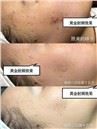 /uploads/202234052/small/microneedling-rf-skin-rejuvenation-machine24263898913.jpg