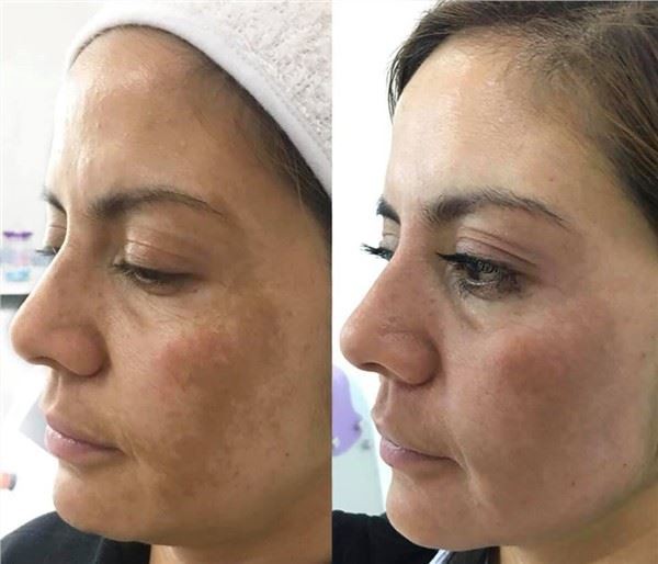 CE approved Q-Switched Laser Tattoo Removal hollywood facial and skin rejuvenataion Machine with local training and warranty in Europe