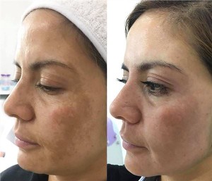 CE approved Q-Switched Laser Tattoo Removal hollywood facial and skin rejuvenataion Machine with local training and warranty in Europe