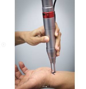 Tattoo Removal Nd Yag Laser