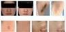 /uploads/202234052/small/verticle-ipl-nyc-3-cold-gentle-hair-removal35507668999.jpg