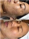 /uploads/202234052/small/verticle-mricroneedling-rf-skin-lifting34273482078.jpg