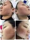 /uploads/202234052/small/verticle-mricroneedling-rf-skin-lifting34277241406.jpg