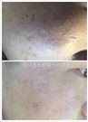 /uploads/202234052/small/verticle-mricroneedling-rf-skin-lifting34283049532.jpg
