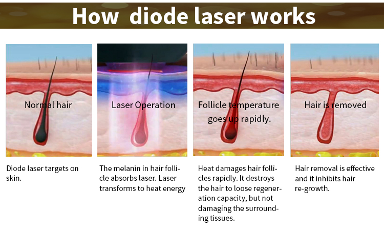 Soprano  Alma xl 808nm painless laser diode laser hair removal user manual