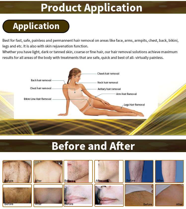 Soprano  Alma xl 808nm painless laser diode laser hair removal user manual