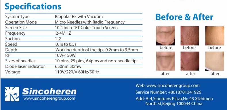 Microneedle Fractional Radiofrequency