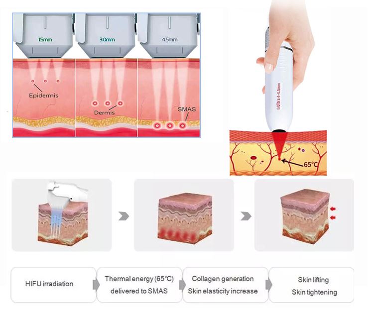 4D HIFU lift the skin