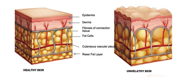 HIFU skin and vagina tightening