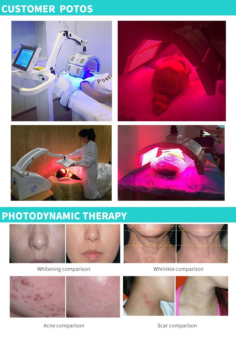 LED Whitening and removing acne