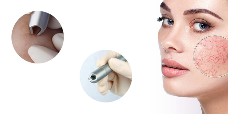 980 diode laser machine