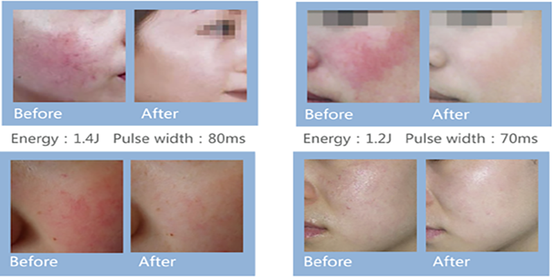 980 diode laser machine before and after 980 diode laser machine before and after