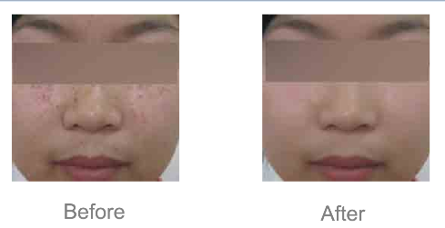 Powerful pico q switch laser tattoo removal machine with Korea imported articulated arm