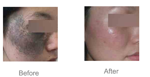 1064 532 755 nd yag laser tattoo removal machine