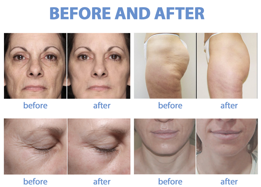 cellushape cavitation rf face and body machine before and after(1)
